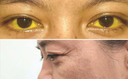 2. Da sạm. Mắc ung thư gan, chức năng gan suy giảm dẫn đến rối loạn nội tiết, sản sinh lượng lớn sắc tố melanin gây ra các triệu chứng như sạm da, vàng mắt, mệt mỏi, chán ăn,...