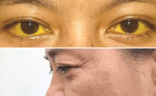 2. Da sạm. Mắc ung thư gan, chức năng gan suy giảm dẫn đến rối loạn nội tiết, sản sinh lượng lớn sắc tố melanin gây ra các triệu chứng như sạm da, vàng mắt, mệt mỏi, chán ăn,...