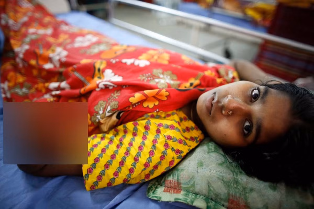 Marium, 16 tuổi, cũng đã mất đi một phần cánh tay trong vụ sập tòa nhà 8 tầng Rana Plaza ở Savar, một tiểu khu gần Dhaka, thủ đô của Bangladesh hồi năm 2013.