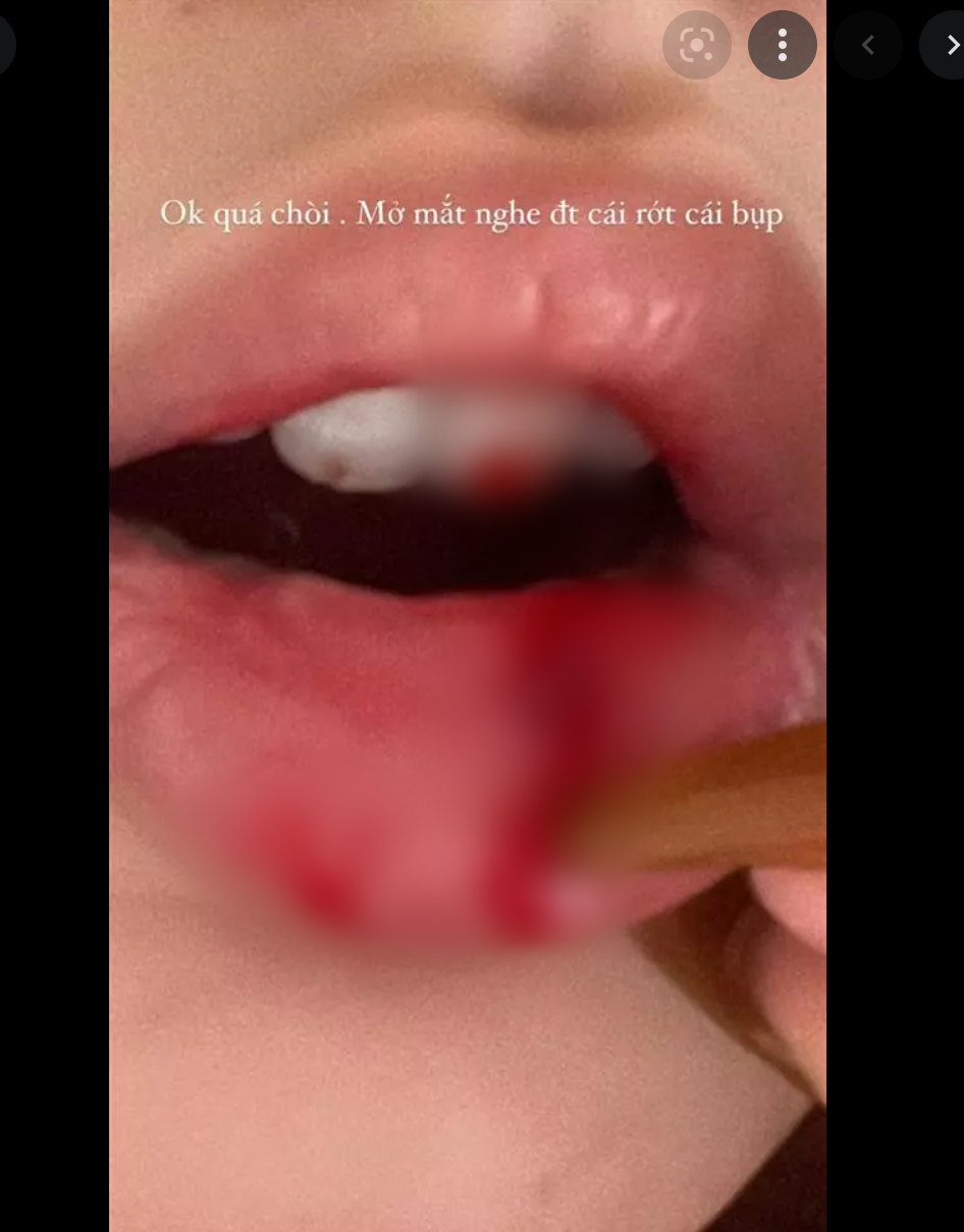 Trên story mới đây Xoài Non xuất hiện với bờ môi máu me be bét, thậm chí dính cả vào răng khiến cư dân mạng không khỏi tò mò, lo lắng.