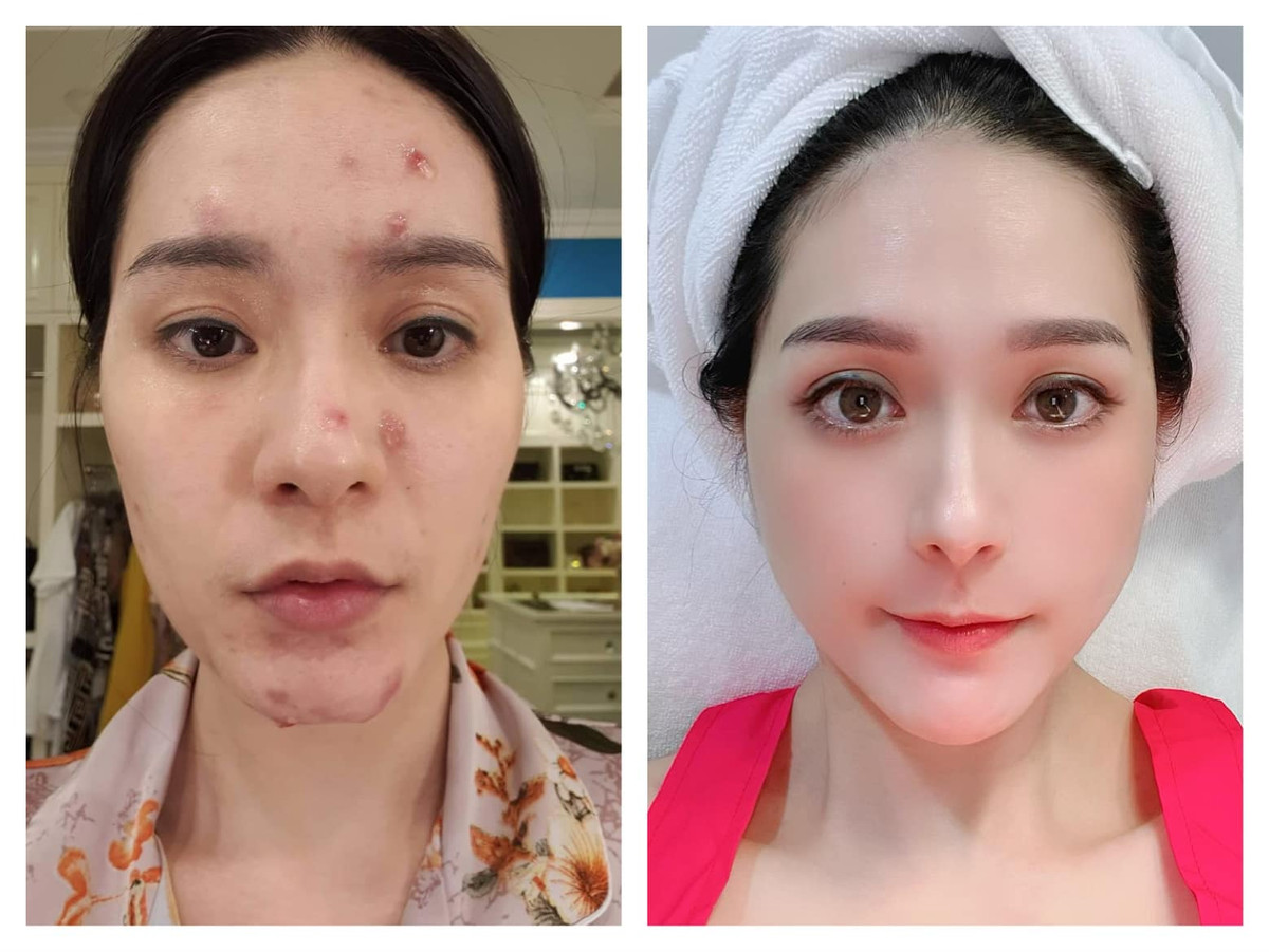 Được biết trước khi đi thẩm mỹ chăm sóc da, nữ đại gia quận 7 từng bị vấn đề về mụn chi chít trên khuôn mặt.
