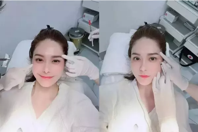 Đoàn Di Băng chăm chỉ tiêm filler thái dương, má, rãnh cười và cằm để trẻ hóa.