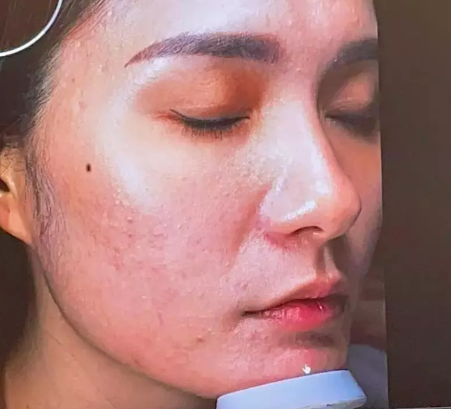 Không chỉ công khai mặt mụn, Di Băng còn từng xuất hiện với làm da sần sùi. Bà xã doanh nhân Quốc Vũ tốn khá thiều thời gian và tiền của để chăm sóc da mặt.