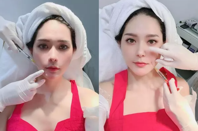 Để níu giữ tuổi trẻ nữ đại gia Đoàn Di Băng đã phải trị mụn, chăm sóc da và tiêm filler nhiều điểm trên mặt.