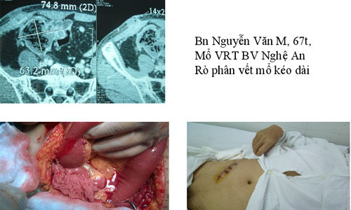 Một trường hợp bệnh nhân bị bác sĩ bỏ quên gạc trong bụng sau khi mổ. Ảnh: TS Nguyễn Đức Chính cung cấp.