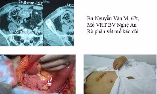 Một trường hợp bệnh nhân bị bác sĩ bỏ quên gạc trong bụng sau khi mổ. Ảnh: TS Nguyễn Đức Chính cung cấp.