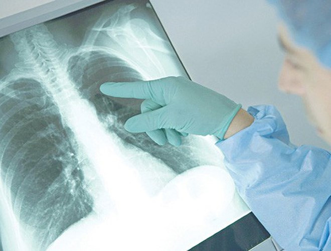 Viêm phổi do nhiễm vi khuẩn: Phổ biến nhất là khuẩn Streptococcus pneumoniae nhưng một số vi khuẩn khác cũng có thể gây viêm phổi. (nguồn: Người lao động)