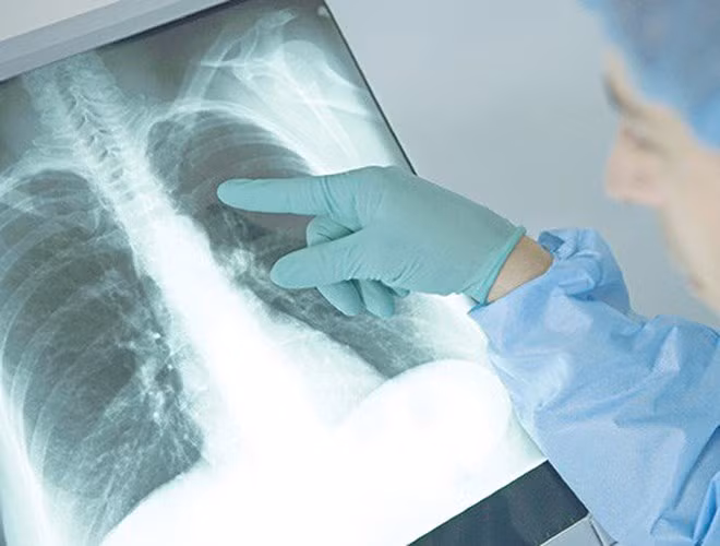Viêm phổi do nhiễm vi khuẩn: Phổ biến nhất là khuẩn Streptococcus pneumoniae nhưng một số vi khuẩn khác cũng có thể gây viêm phổi. (nguồn: Người lao động)