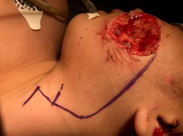 Bệnh nhi này là bé gái L.T.P. (8 tuổi). Khi đang chơi đùa với cô chủ, con chó nuôi bất ngờ nổi điên đè bé gái xuống cắn nát vùng mặt bên trái. Nạn nhân nhập viện trong tình trạng mất gần như toàn bộ vùng da, cơ của má trái, các bác sĩ phải phẫu thuật vạt da cổ, tạo hình lại vùng mặt cho bé. 