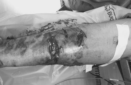 Mới đây, một bệnh viện tư tại TPCM đã tiếp nhận cấp cứu cho hai vợ chồng bị thương rất nặng do chó Becgie 3 năm tuổi được gia đình cưng chiều tấn công. Cả hai nạn nhân được chuyển đến với nhiều vết thương nham nhở, trong đó cụ ông là H.Đ.D (73 tuổi) bị thương rất nặng các vết thương tập trung chủ yếu ở 2 tay và 2 chân. Tay phải của cụ là vùng bị nặng nhất, cẳng tay đứt nát gân, cơ, đứt cấu trúc động mạch quay, đứt dây thần kinh. Vợ của ông là bà B.T.K (65 tuổi) cũng bị con vật tấn công nhưng may mắn chỉ bị rách da, tổn thương phần mềm ở chân.