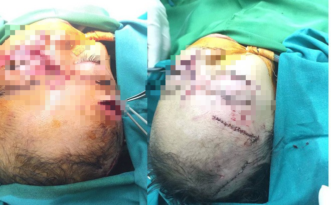 Bé T.T.H.Y (31 tháng tuổi), trú tại xã Nam Sơn, huyện Đô Lương, Nghệ An bị chó nhà cắn nhiều nhát vào đầu và mặt phải nhập viện cấp cứu. Qua thăm khám, các bác sỹ xác định cháu Y. bị nhiều vết thương hở, chảy máu nhiều ở đầu, mặt. Vùng quanh mí mắt trái sâu, mất hết tổ chức. Ở trán cháu Y có vết thương sâu sát xương. 