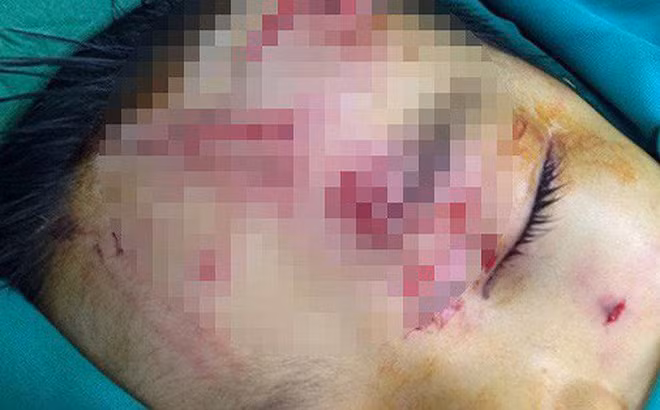 Chiều ngày 20/12, khi cháu N.T.K (7 tuổi) đang chơi một mình ở ngoài sân thì bị chính con chó của gia đình xông vào tấn công. Con chó tấn công người và đã cắn nát một phần mặt của cháu bé. Sau nhiều ngày điều trị, sức khỏe của cháu K. đã ổn định hơn, các vết thương trên khuôn mặt cũng đang lành lại. 