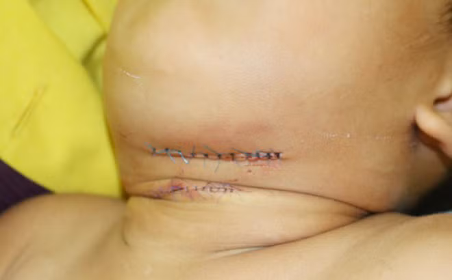 Tháng 9/2018, Bệnh viện Việt Nam - Thuỵ Điển Uông Bí đã tiếp nhận trường hợp một bệnh nhi (4 tuổi) trú tại xã Điền Công – TP Uông Bí nhập viện với nhiều vết thương vùng mặt và vùng cổ. Đáng nói, cách đây 1 năm, bé cũng đã từng bị chó nhà tấn công. Các bác sĩ thông tin, vết thương của bệnh nhi tại vùng mặt không có gì đáng ngại nhưng vết thương tại vùng cổ của bệnh nhi rất nguy hiểm có nguy cơ ảnh hưởng đến tính mạng 