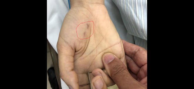 Chị Phan Thị C. (24 tuổi, Phú Xuyên, Hà Nội) là bác sĩ thú y đang làm việc tại một phòng khám tư nhân tại Phú Thọ. Trước khi vào viện gần hai tháng, trong lúc đang làm việc, bệnh nhân bị chó ốm cắn vào tay, vết cắn ở vị trí bàn tay phải. Sau khi bị cắn, bệnh nhân đã sơ cứu, rửa vết thương, sát trùng và băng lại. Nhưng do không tiểm phòng dại, tình hình sức khỏe của chị càng lúc càng suy giảm và đã bị tử vong sau đó vài ngày. Theo người nhà bệnh nhân, hai người khác cũng bị con chó này đã cắn nhưng đã đi tiêm phòng và thoát chết