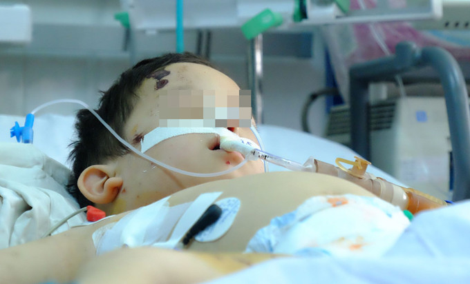 Đây là bé trai L.N.T.L 1 tuổi (Đăk Lăk) được đưa vào bệnh viện vào ngày 4/1/2018 với tình trạng mặt biến dạng, mất một mảng thịt lớn, toàn bộ phần mũi gần như đã đứt lìa. Người nhà của cậu bé cho biết, khi người mẹ đang nấu ăn dưới bếp thì nghe tiếng gào khóc của con, đến khi chạy lên thì kinh hãi thấy cảnh con chó nhà nuôi đang vồ lấy bé và cắn liên tiếp vào mặt. Sau đó bé đã được phẫu thuật ghép vào và cố gắng bảo tồn bằng cách tiêm kháng sinh liều cao để tránh nhiễm trùng, tuy nhiên các bác sĩ không thể tiên lượng được tình trạng sau này của bé. 