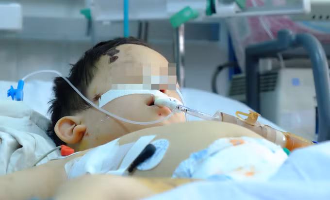 Đây là bé trai L.N.T.L 1 tuổi (Đăk Lăk) được đưa vào bệnh viện vào ngày 4/1/2018 với tình trạng mặt biến dạng, mất một mảng thịt lớn, toàn bộ phần mũi gần như đã đứt lìa. Người nhà của cậu bé cho biết, khi người mẹ đang nấu ăn dưới bếp thì nghe tiếng gào khóc của con, đến khi chạy lên thì kinh hãi thấy cảnh con chó nhà nuôi đang vồ lấy bé và cắn liên tiếp vào mặt. Sau đó bé đã được phẫu thuật ghép vào và cố gắng bảo tồn bằng cách tiêm kháng sinh liều cao để tránh nhiễm trùng, tuy nhiên các bác sĩ không thể tiên lượng được tình trạng sau này của bé. 