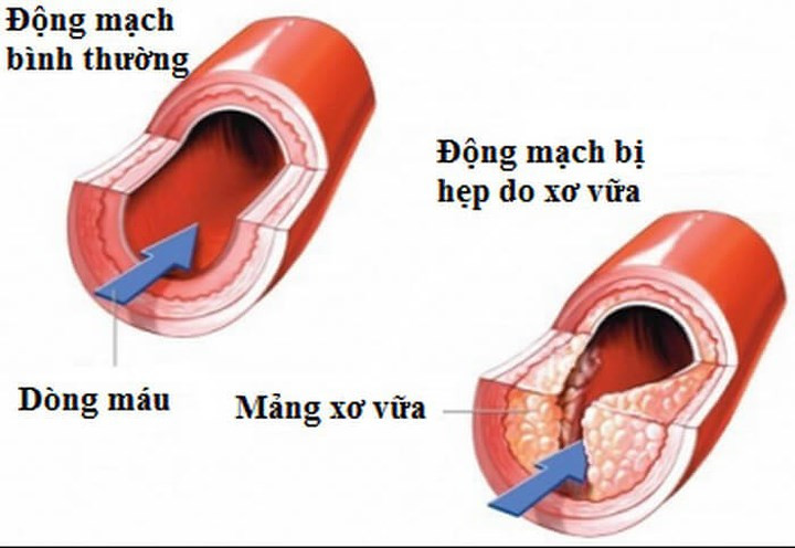 Bệnh xơ vữa động mạch não: Khi bạn mắc các bệnh về cao huyết áp, đường trong máu cao, mỡ máu cao, hoặc có các thói quen xấu như hút thuốc, uống rượu, ngồi nhiều ít vận động, đều có thể sẽ dẫn đến chứng máu vón cục, độ nhớt máu cao gây ra xơ vữa động mạch não. Khi mạch máu bị thu hẹp, việc cung cấp máu lên não sẽ giảm.