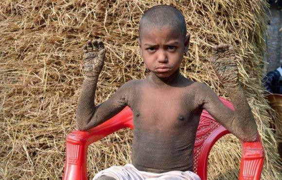 Mac benh da lieu hiem gap, ca nguoi cau be sap 