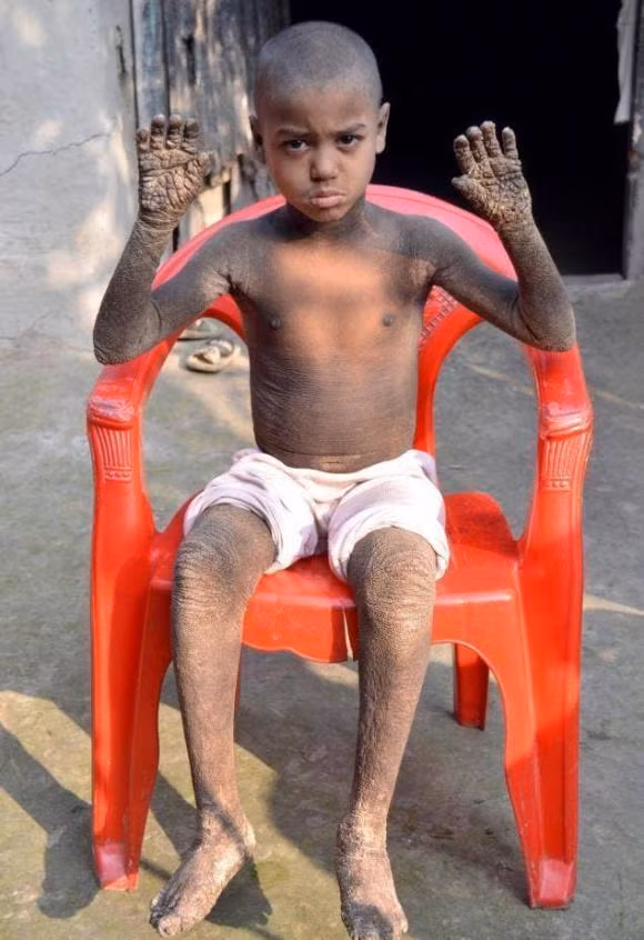 Mac benh da lieu hiem gap, ca nguoi cau be sap 