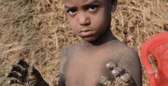 Mac benh da lieu hiem gap, ca nguoi cau be sap 