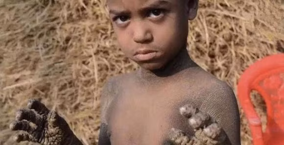 Mac benh da lieu hiem gap, ca nguoi cau be sap 