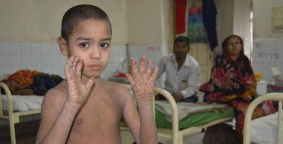 Mac benh da lieu hiem gap, ca nguoi cau be sap 