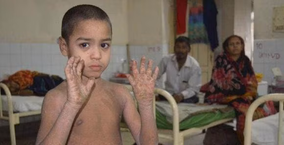 Mac benh da lieu hiem gap, ca nguoi cau be sap 