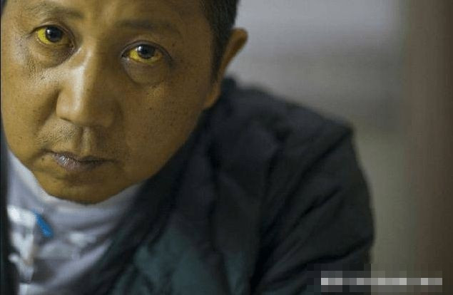 3. Tăng mụn trứng cá: Mụn bọc hay còn gọi là mụn trứng cá xuất hiện nhiều cũng là dấu hiệu của bệnh gan, Nhiều người cho rằng mụn nổi lên là do họ thường xuyên ăn đồ cay. Trên thực tế, điều này cũng có thể do gan kém.