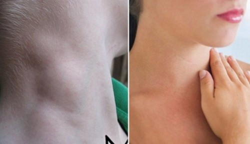 Tuy nhiên, nếu khối u lớn hơn 2cm, hoặc có cảm giác như chùm nho, mặc dù không đau nhưng mãi không hết, không đỡ, không lặn đi thì lập tức đến bệnh viện ngay.