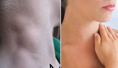 Tuy nhiên, nếu khối u lớn hơn 2cm, hoặc có cảm giác như chùm nho, mặc dù không đau nhưng mãi không hết, không đỡ, không lặn đi thì lập tức đến bệnh viện ngay.