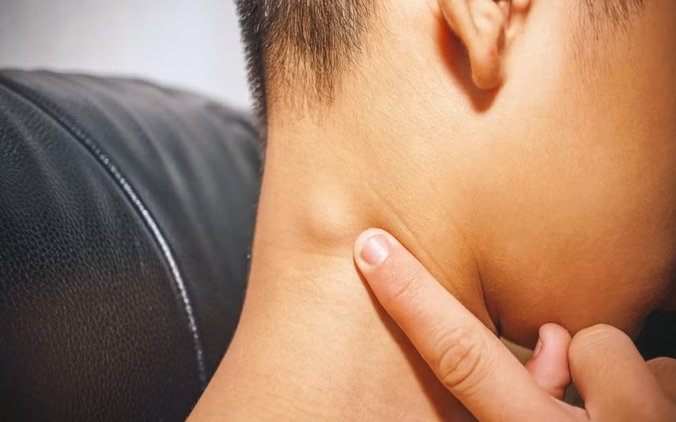 Bên cạnh đó, có 6 dấu hiệu triệu chứng đi kèm với khối u, đặc trưng cho bệnh ung thư hạch bạch huyết, bao gồm: Sốt; đổ mồ hôi ban đêm; ngứa da; trong vòng nửa năm, cân nặng sụt mất 10% so với trọng lượng ban đầu; thở khó, ho nhiều và tăng bạch huyết bất thường. Lưu ý, nếu các dấu hiệu trên kèm theo sưng hạch, bạn nên đi khám càng sớm càng tốt.