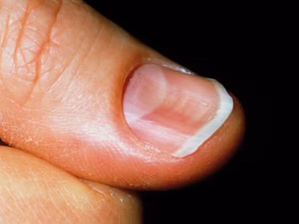 Trong cuộc sống hàng ngày, hãy chú ý nhiều hơn đến tình trạng của móng chân, nếu phát hiện có dấu hiệu bất thường nên đi khám kịp thời, tuyệt đối không nên trì hoãn, có thể gây ra những hệ quả rất khó chịu về sau.