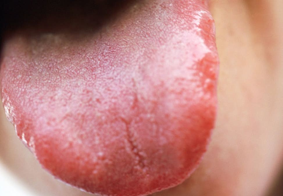 Bệnh nhân viêm lưỡi teo không có lớp phủ lưỡi, lưỡi trơn bóng hơn người thường, màu sắc hồng hào hơn, nhìn bề ngoài giống thịt bò nên còn được gọi là “lưỡi bò”, tình trạng này thường xảy ra ở những người ăn chay và thiếu vitamin B12.