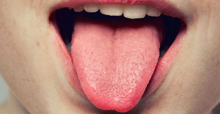 Bệnh nhiễm nấm này có khả năng xảy ra ở những người có khả năng miễn dịch suy yếu, nó phát triển ở những mảng bám trong miệng và trên lưỡi, có thể có màu trắng nhạt hoặc trắng đục, gây hôi miệng.