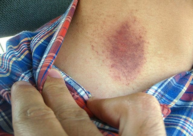 Bên cạnh đó, vết hickey không thể xóa, mà phải đợi cơ thể tự lành lại. Quá trình này có thể kéo dài khoảng 2 tuần, nhưng nếu lâu hơn đó là dấu hiệu cho thấy bạn thiếu sắt trầm trọng.