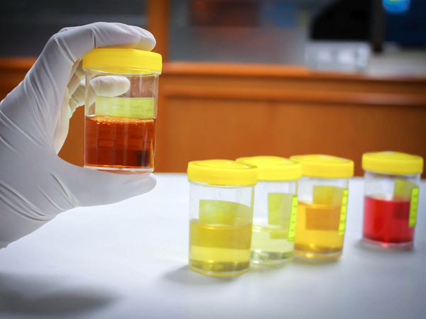 Màu đỏ: Nếu thấy nước tiểu màu đỏ, đây có thể là do máu hòa lẫn vào hay nói cách khác là tiểu ra máu. Nguyên nhân chủ yếu là do sỏi thận hoặc nhiễm trùng tiết niệu, cũng có thể do thay đổi màu sắc do thận tổn thương...