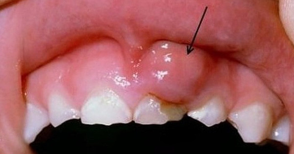 Bệnh viêm loét miệng cứ tái đi tái lại là sao? Loét miệng tái phát không có thời gian khởi phát cụ thể và có thể xảy ra quanh năm. Bệnh không cố định nhóm đối tượng, có thể xảy ra ở cả nam giới, phụ nữ và trẻ em, nhưng tỷ lệ mắc bệnh ở nữ cao hơn nam một chút.