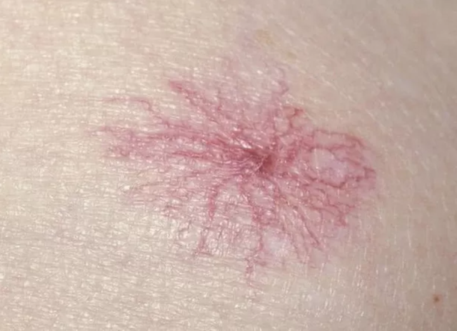 Thứ ba, nốt ruồi nhện xuất hiện. Đây là một trong những dấu hiệu rõ ràng hơn của tổn thương gan. Nốt ruồi nhện, đúng như tên gọi, là một mảng màu đỏ giống như mạng nhện. Điều này xảy ra do gan bị tổn thương và không thể bất hoạt lượng estrogen dư thừa trong cơ thể, hormone này sẽ kích thích các mạch máu giãn nở, tạo ra nốt ruồi nhện.