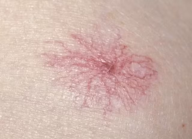 Thứ ba, nốt ruồi nhện xuất hiện. Đây là một trong những dấu hiệu rõ ràng hơn của tổn thương gan. Nốt ruồi nhện, đúng như tên gọi, là một mảng màu đỏ giống như mạng nhện. Điều này xảy ra do gan bị tổn thương và không thể bất hoạt lượng estrogen dư thừa trong cơ thể, hormone này sẽ kích thích các mạch máu giãn nở, tạo ra nốt ruồi nhện.