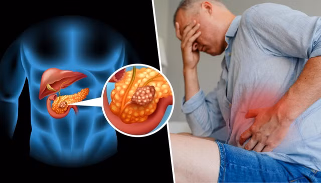 Những người có nguy cơ cao bị ung thư tuyến tụy là ai? Những người trên 40 tuổi và kèm theo bất kỳ trường hợp nào sau đây là đối tượng có nguy cơ cao mắc bệnh ung thư tuyến tụy và cần cảnh giác cao độ, tầm soát thường xuyên: