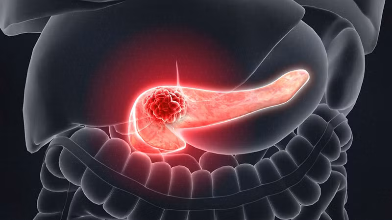 3. Cảnh giác với những manh mối có thể có của ung thư tuyến tụy và kiểm tra kịp thời: Nguyên nhân khiến bệnh ung thư tuyến tụy được phát hiện muộn là do các triệu chứng của bệnh ung thư tuyến tụy vô cùng điển hình và dễ bị nhầm lẫn với các bệnh khác, vì vậy chúng ta phải hết sức cảnh giác trước một số manh mối đáng ngờ.