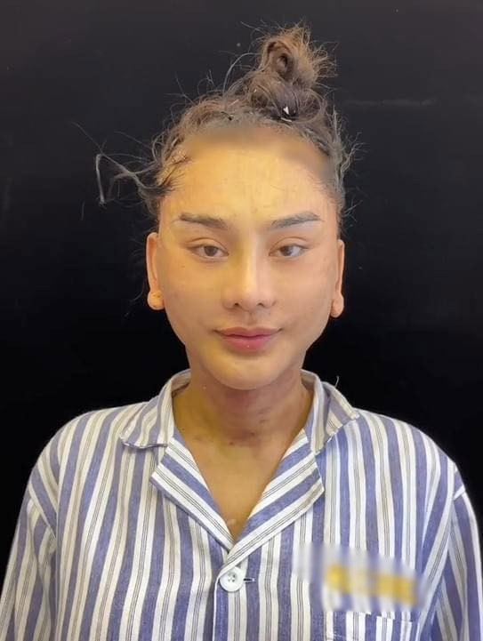 Khuôn mặt của Lâm Khánh Chi sau khi vừa kết thúc cuộc phẫu thuật thẩm mỹ căng da mặt ở Trung Quốc. (Ảnh: Người đưa tin)