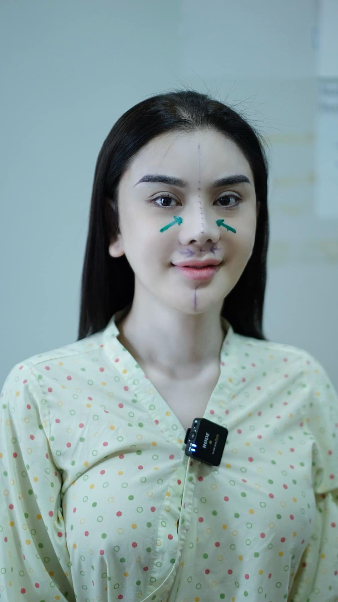 Lâm Khánh Chi cho biết lý do lần thứ hai cô can thiệp "dao kéo" ở bộ phận này vì mũi cũ bị gãy.