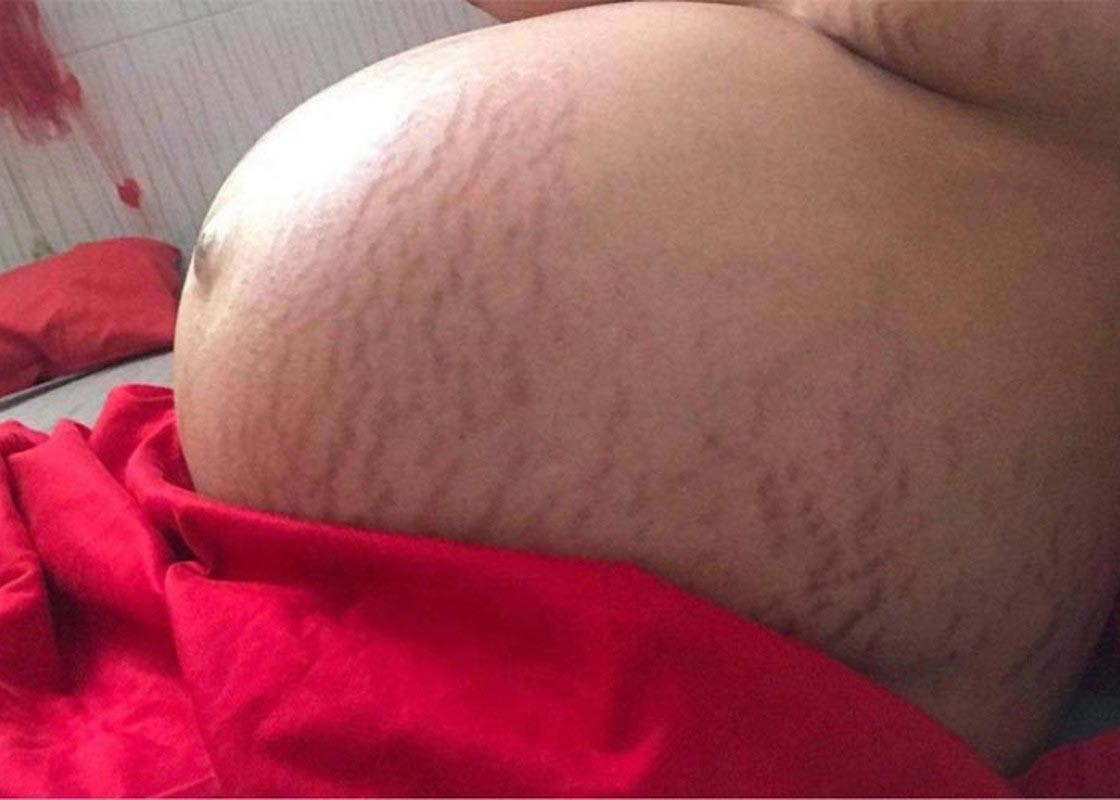 Khuôn mặt nổi đầy mụn, thâm chi chít, bụng bị rạn khi Hoa hậu Đại dương Việt Nam 2014 mang thai đôi hai con trai.