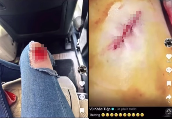 Vùng đầu gối của chân dài 8X bị rách da chảy máu, phải khâu.