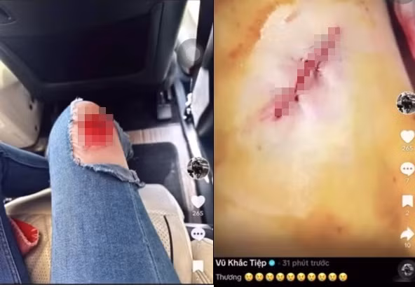 Vùng đầu gối của chân dài 8X bị rách da chảy máu, phải khâu.