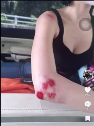 Vùng bả vai và khuỷu tay của Ngọc Trinh cũng bị trầy xước chảy máu.