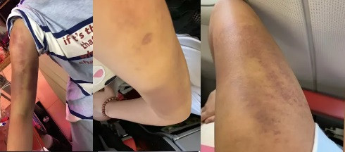 Khắc nghiệt hơn, nữ ca sĩ sinh năm 2003 ra sức nhào nặn cơ thể với hy vọng có thể đốt mỡ. Hậu quả kéo theo là những cơn đau đớn cùng những vết bầm tím trên cơ thể suốt 2 tháng mới biến mất.