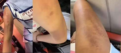 Khắc nghiệt hơn, nữ ca sĩ sinh năm 2003 ra sức nhào nặn cơ thể với hy vọng có thể đốt mỡ. Hậu quả kéo theo là những cơn đau đớn cùng những vết bầm tím trên cơ thể suốt 2 tháng mới biến mất.