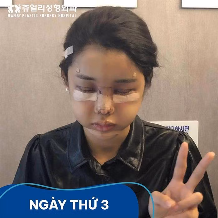 Người đẹp sinh năm 1995 sang Hàn Quốc để thực hiện hạ gò má, gọt hàm, cắt mí mắt, hạ góc đuôi mắt, sửa mũi.